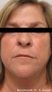 Facial Rejuvenation