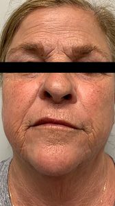 Facial Rejuvenation