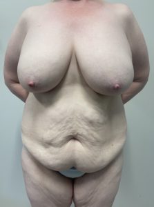 Mommy Makeover
