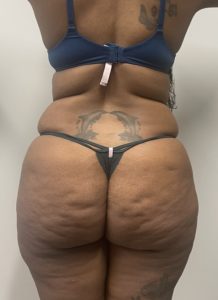 Liposuction