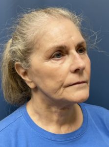 Face Lift