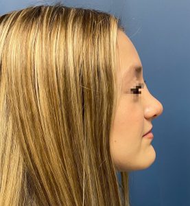 Rhinoplasty