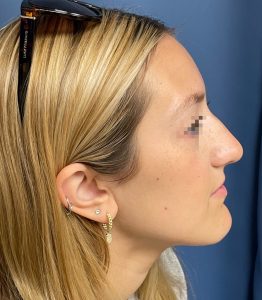 Rhinoplasty