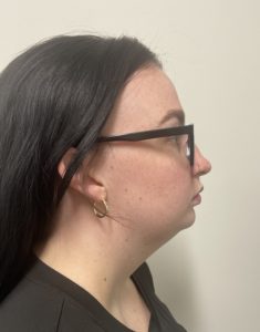 Liposuction with Chin Implant