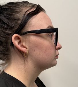 Liposuction with Chin Implant